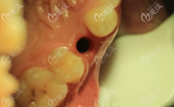 单颗缺失种植牙设计 单颗缺失种植牙设计