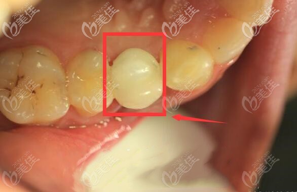 韩系单颗种植牙案例 韩系单颗种植牙案例