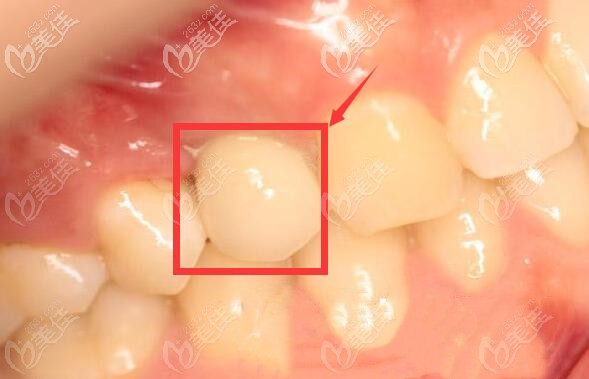 解答:天津河西区雅尔美口腔做单颗韩系种植牙需要多长时间