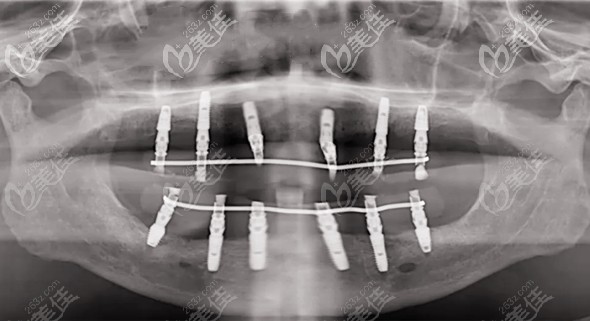 更新烟台圣贝口腔的显微镜种植牙案例,属于微创即刻种植修复