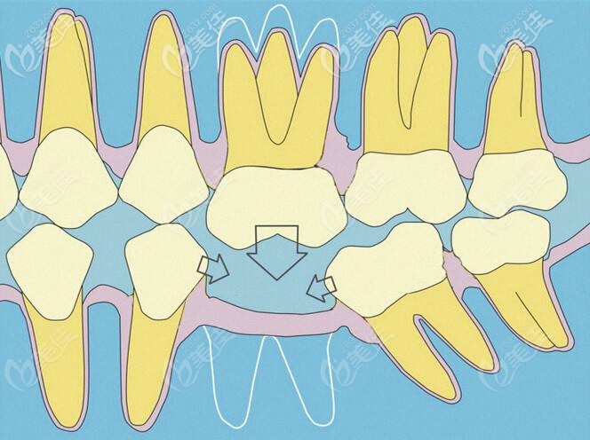 单颗牙齿缺失的危害