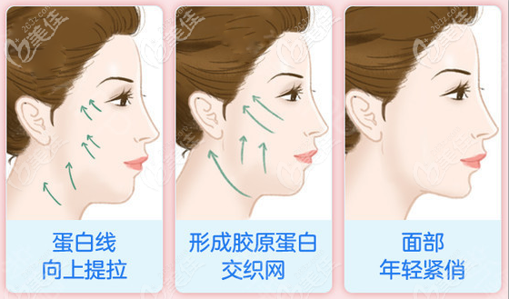 深圳鹏程医院周毅涛医生埋线提升效果 深圳鹏程医院周毅涛医生埋线提升效果