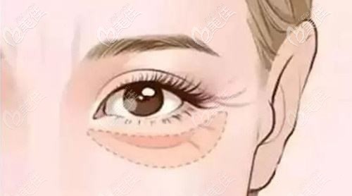 卧蚕过大会容易形成眼袋 卧蚕过大会容易形成眼袋