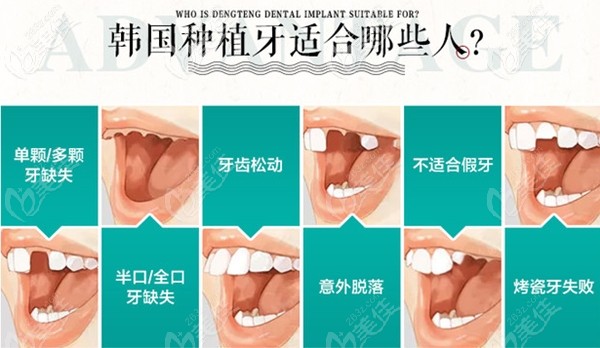 适合做种植牙的人群 适合做种植牙的人群