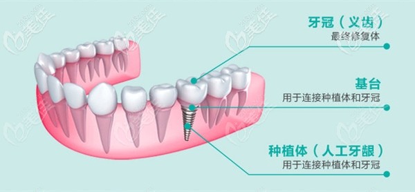 种植牙机构示意图 种植牙机构示意图