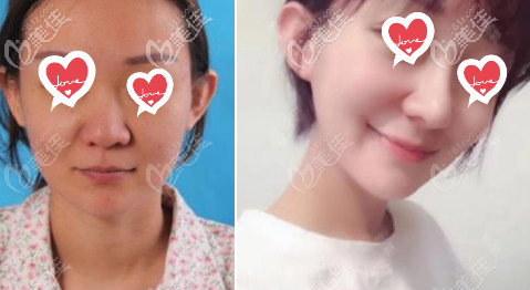 北京美莱隆鼻案例 北京美莱隆鼻案例