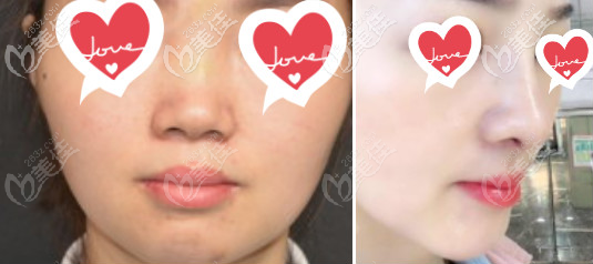 北京柏丽隆鼻案例 北京柏丽隆鼻案例