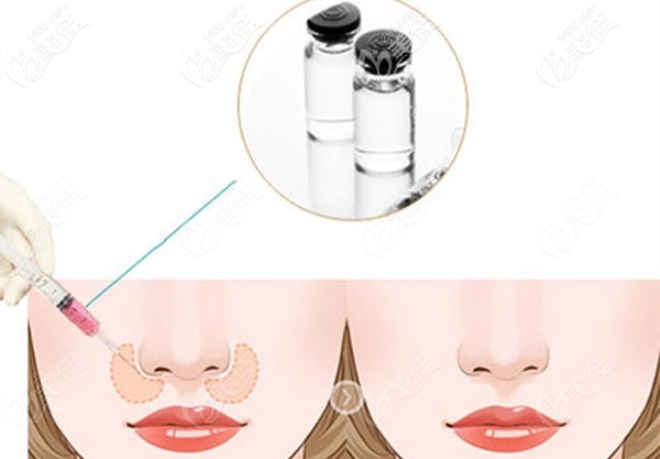 注射法改善鼻基底凹陷导致的法令纹
