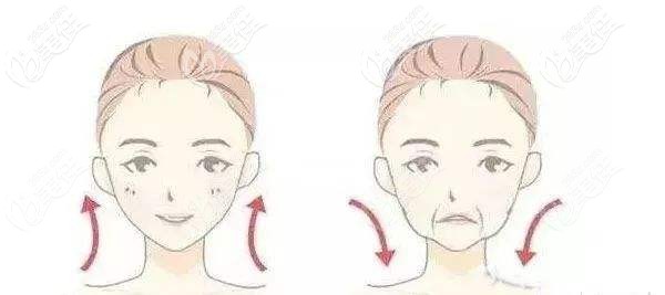 衰老型法令纹呈现的效果