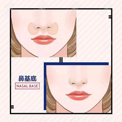 鼻基底凹陷造成的少女型法令纹