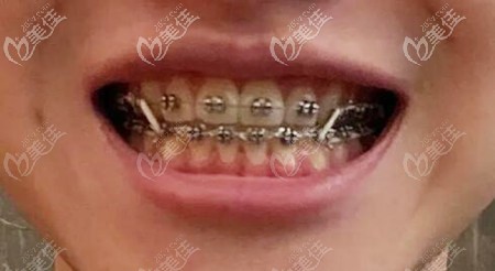 成人地包天牙齿矫正案例:戴的是美国奥美科金属自锁矫正器