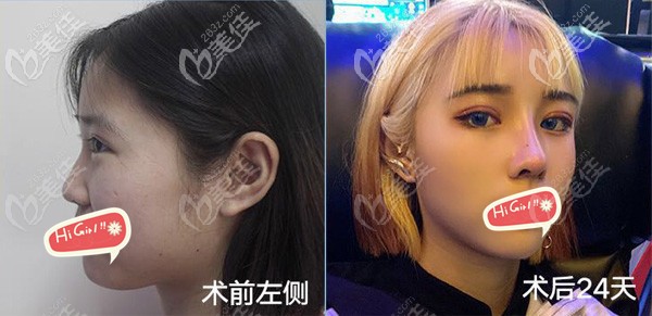 双眼皮修复+肋软骨隆鼻术后一个月对比效果