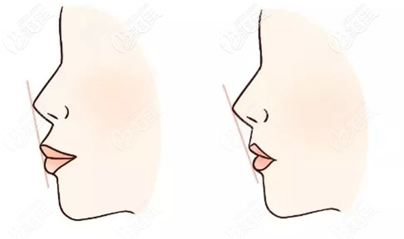 骨性龅牙凸嘴是做正颌还是正畸好呢