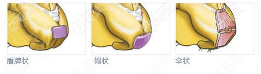 成都西区医院8C骨雕鼻技术优势