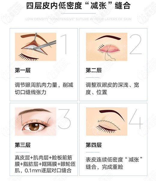 贝塞尔10°美眼综合技术优势