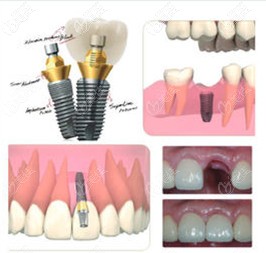 韩国登腾种植体
