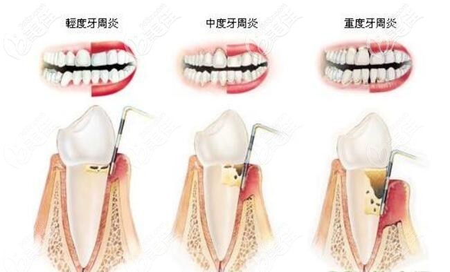 牙周炎中期早期晚期的区别图片
