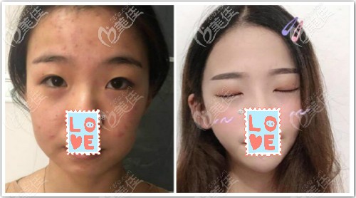 德国艾pcl线v8全脸提升三个月效果对比图 德国艾pcl线v8全脸提升三个月效果对比图