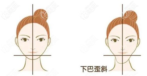 下巴歪斜的原因 下巴歪斜的原因