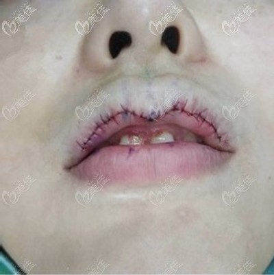 这是我做M唇手术第3天照片