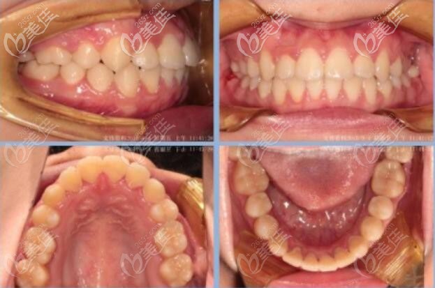 娄底爱牙邦口腔牙齿矫正后 娄底爱牙邦口腔牙齿矫正后