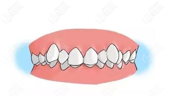 虎牙应该选择矫正牙齿吗 虎牙应该选择矫正牙齿吗