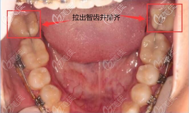 从金属活动翼技术矫正凸面型的案例中,看如何扶正歪倒的智齿
