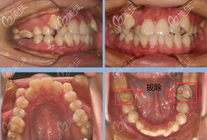 娄底爱牙口腔矫正前案例图片 娄底爱牙口腔矫正前案例图片