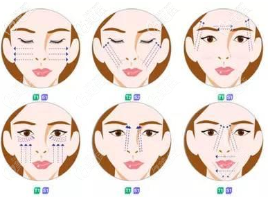 面部埋线提升常见的部位 面部埋线提升常见的部位