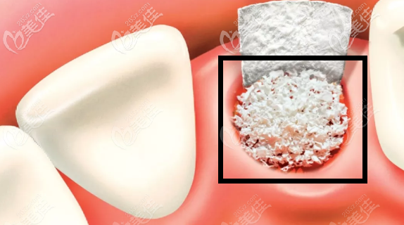 种植牙需要的骨粉