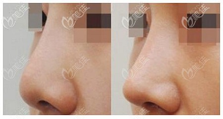 东莞天后耳软骨隆鼻效果前后对比
