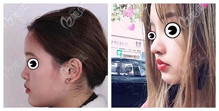 东莞壹加壹耳软骨隆鼻案例