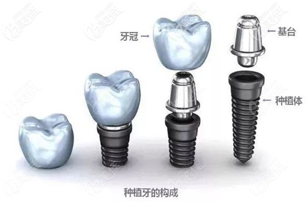 国产种植体和进口种植体的区别