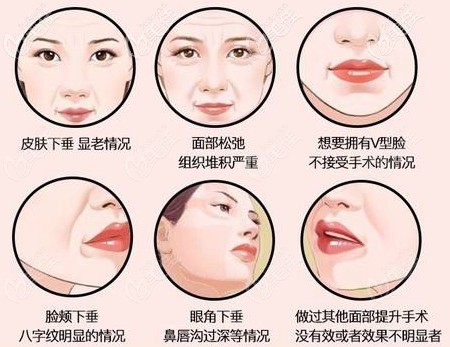 面部埋线提升可以改善的问题 面部埋线提升可以改善的问题