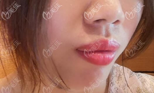 骨性凸嘴在邛崃新桥口腔做矫正前的照片 骨性凸嘴在邛崃新桥口腔做矫正前的照片