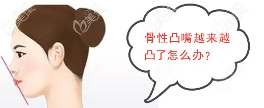 骨性凸嘴会越来越凸吗 骨性凸嘴会越来越凸吗