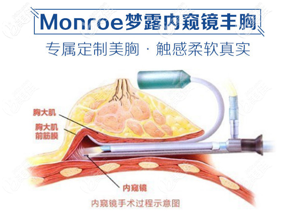 广东美恩刘祥厦医生隆胸怎么样 广东美恩刘祥厦医生隆胸怎么样