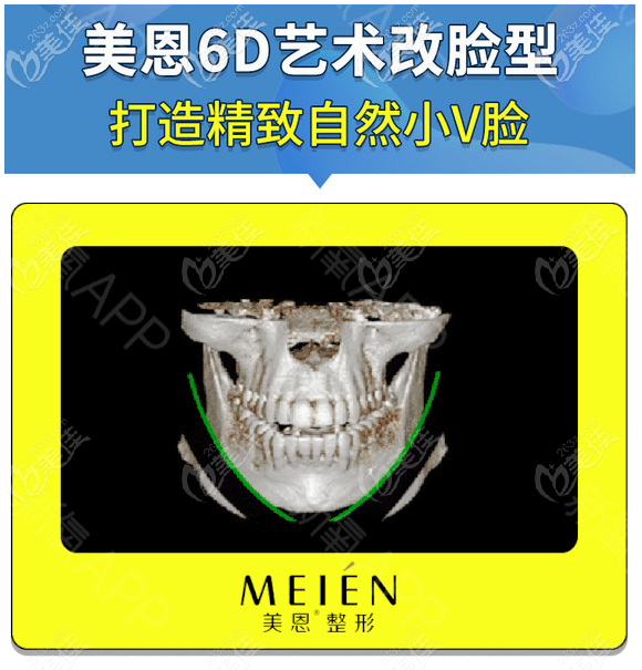 广东美恩刘祥厦医生磨骨怎么样 广东美恩刘祥厦医生磨骨怎么样