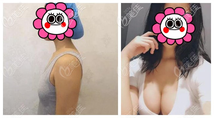 罗盛康隆胸技术怎么样? 罗盛康隆胸技术怎么样?