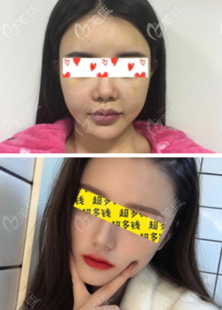 重庆郑荃丽格可以做面部脂肪填充失败修复吗