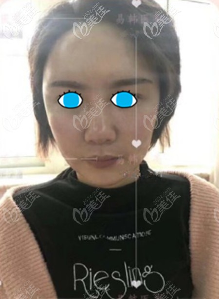 真没想到40岁的我在信阳东方艺做面部自体脂肪填充后，还可以这么美