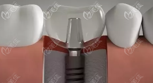 种植牙的修复技术有多种