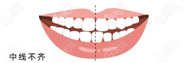 牙性偏颌示意图