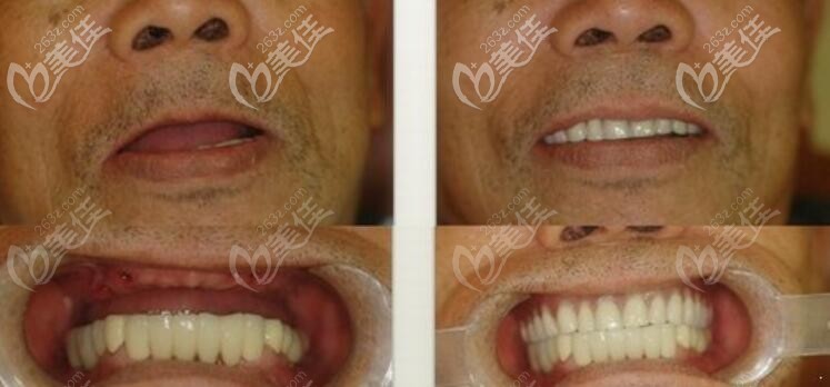 老年人牙缺失做全口种植牙案例前后效果对比图 老年人牙缺失做全口种植牙案例前后效果对比图
