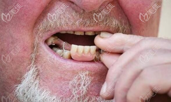 老年人牙缺失做活动义齿案例图