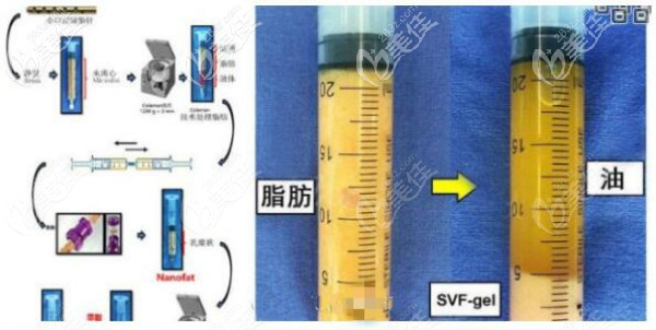 SVF脂肪胶和自体脂肪丰胸示意图区别