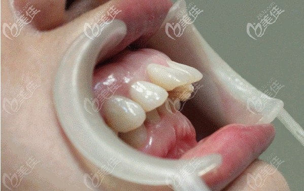 我的小龅牙 我的小龅牙