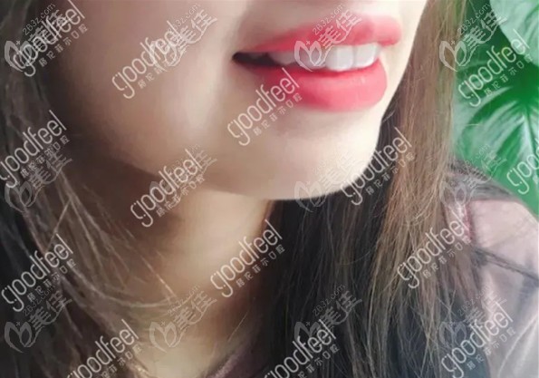 刚带上牙套的图片 刚带上牙套的图片