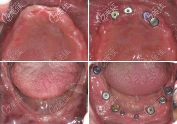 厦门峰煜口腔全口缺失案例 厦门峰煜口腔全口缺失案例