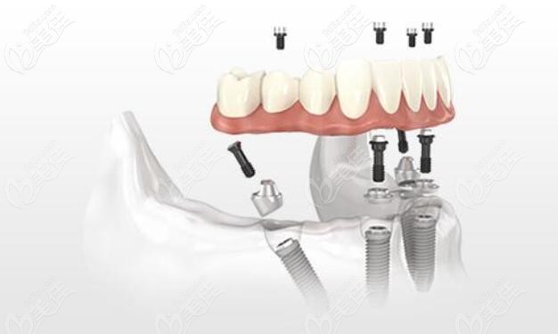 半口all-on-4种植牙 半口all-on-4种植牙